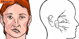 როგორ დავადგინოთ ინსულტი? მარტივი მეთოდი, რომლითაც ადამიანის სიცოცხლეს გადაარჩენთ.