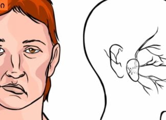 როგორ დავადგინოთ ინსულტი? მარტივი მეთოდი, რომლითაც ადამიანის სიცოცხლეს გადაარჩენთ.