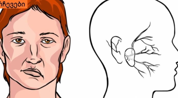 როგორ დავადგინოთ ინსულტი? მარტივი მეთოდი, რომლითაც ადამიანის სიცოცხლეს გადაარჩენთ.