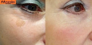 იცოდით აქამდე? ასაკობრივი ლაქების მოცილება სახლშიც შესაძლებელია.