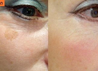 იცოდით აქამდე? ასაკობრივი ლაქების მოცილება სახლშიც შესაძლებელია.