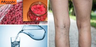 თრომბოფლებიტი: სიმპტომები, მკურნალობა და პრევენცია. (რა შუაშია წყალი და ჟოლო ამ დაავადებასთან)