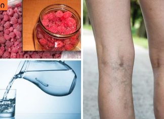 თრომბოფლებიტი: სიმპტომები, მკურნალობა და პრევენცია. (რა შუაშია წყალი და ჟოლო ამ დაავადებასთან)