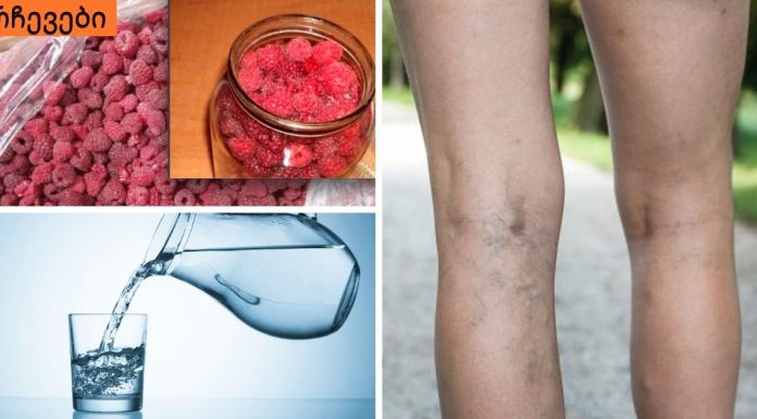 თრომბოფლებიტი: სიმპტომები, მკურნალობა და პრევენცია. (რა შუაშია წყალი და ჟოლო ამ დაავადებასთან)