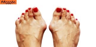 როგორ მოვიშოროთ ძვლები ფეხზე. უმარტივესი რეცეპტი .