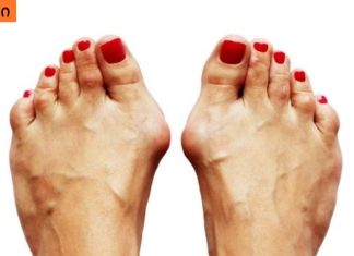 როგორ მოვიშოროთ ძვლები ფეხზე. უმარტივესი რეცეპტი .