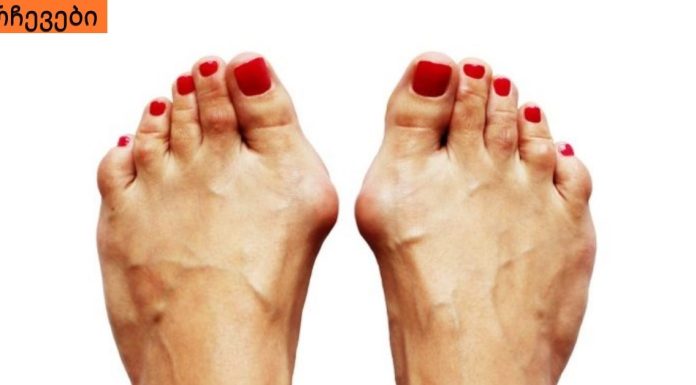 როგორ მოვიშოროთ ძვლები ფეხზე. უმარტივესი რეცეპტი .