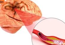 თავის ტვინის სისხლძარღვების ათეროსკლეროზი: რა არის საჭირო და მნიშვნელოვანია იცოდეთ ამის შესახებ