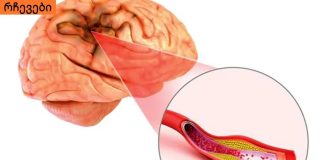 თავის ტვინის სისხლძარღვების ათეროსკლეროზი: რა არის საჭირო და მნიშვნელოვანია იცოდეთ ამის შესახებ