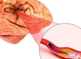 თავის ტვინის სისხლძარღვების ათეროსკლეროზი: რა არის საჭირო და მნიშვნელოვანია იცოდეთ ამის შესახებ