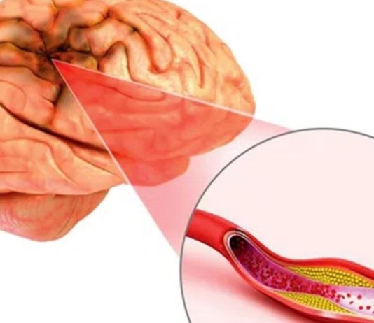 თავის ტვინის სისხლძარღვების ათეროსკლეროზი: რა არის საჭირო და მნიშვნელოვანია იცოდეთ ამის შესახებ