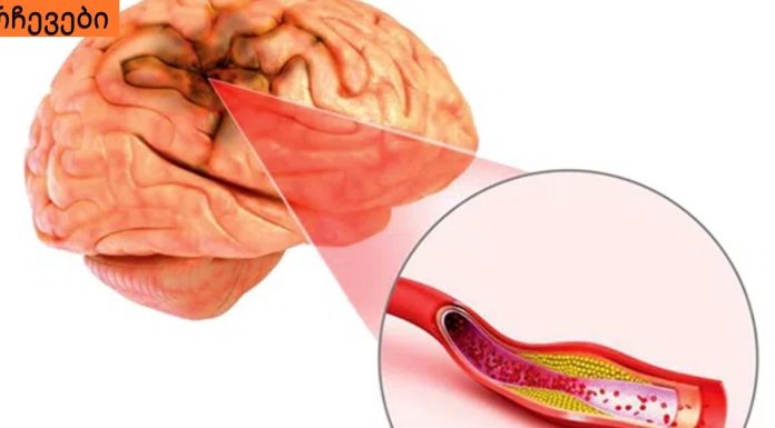 თავის ტვინის სისხლძარღვების ათეროსკლეროზი: რა არის საჭირო და მნიშვნელოვანია იცოდეთ ამის შესახებ