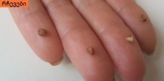 ჰიპერტენზია (წნევა ): როგორ დავეხმაროთ საკუთარ თავს ტაბლეტების გარეშე? სწრაფი და ეფექტური გზა!