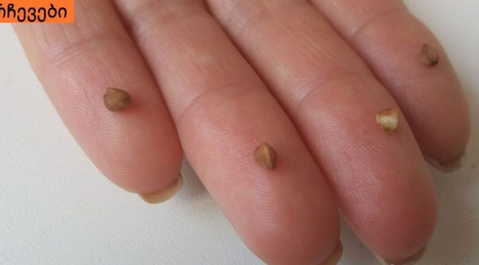 ჰიპერტენზია (წნევა ): როგორ დავეხმაროთ საკუთარ თავს ტაბლეტების გარეშე? სწრაფი და ეფექტური გზა!