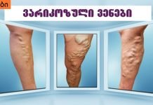 სახლში ყველა ჩვენგან აქვს ვარიკოზის საწინააღმდეგო ეს საშუალება, მაგრამ ამის შესახებ არავინ იცის..