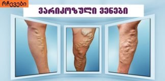 სახლში ყველა ჩვენგან აქვს ვარიკოზის საწინააღმდეგო ეს საშუალება, მაგრამ ამის შესახებ არავინ იცის..