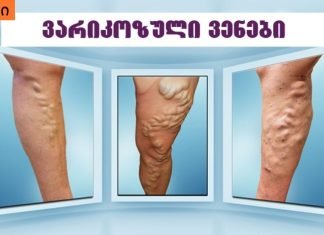 სახლში ყველა ჩვენგან აქვს ვარიკოზის საწინააღმდეგო ეს საშუალება, მაგრამ ამის შესახებ არავინ იცის..