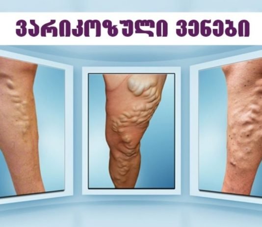 სახლში ყველა ჩვენგან აქვს ვარიკოზის საწინააღმდეგო ეს საშუალება, მაგრამ ამის შესახებ არავინ იცის..