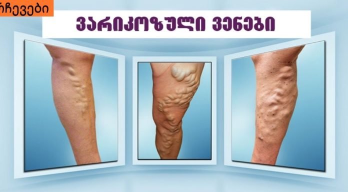 სახლში ყველა ჩვენგან აქვს ვარიკოზის საწინააღმდეგო ეს საშუალება, მაგრამ ამის შესახებ არავინ იცის..