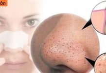 ამ უმარტივესი და ეფექტური ნიღბების დახმარებით, შავ წერტილებს სამუდამოდ მოიშორებთ!