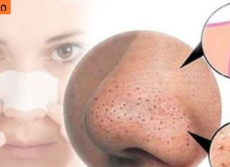 ამ უმარტივესი და ეფექტური ნიღბების დახმარებით, შავ წერტილებს სამუდამოდ მოიშორებთ!