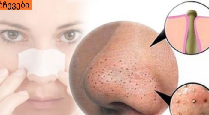 ამ უმარტივესი და ეფექტური ნიღბების დახმარებით, შავ წერტილებს სამუდამოდ მოიშორებთ!