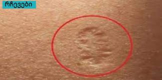 იცით თუ არა ამ მცირე ნაწიბურების საიდუმლო მარცხენა მკლავზე? ეს არის ის, რომელზეც ყოველთვის კითხვა ჩნდება.