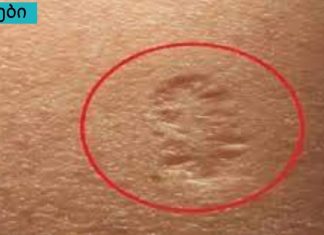 იცით თუ არა ამ მცირე ნაწიბურების საიდუმლო მარცხენა მკლავზე? ეს არის ის, რომელზეც ყოველთვის კითხვა ჩნდება.