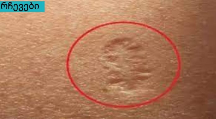 იცით თუ არა ამ მცირე ნაწიბურების საიდუმლო მარცხენა მკლავზე? ეს არის ის, რომელზეც ყოველთვის კითხვა ჩნდება.