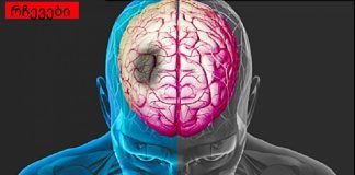 რა მიგანიშნებთ ინსულტზე? ის, რასაც ყველა უნდა დააკვირდეს