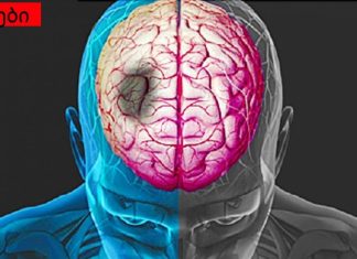 რა მიგანიშნებთ ინსულტზე? ის, რასაც ყველა უნდა დააკვირდეს