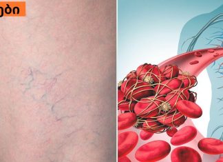 ვასკულიტი: რა უნდა იცოდეთ სისხლძარღვთა ანთების შესახებ