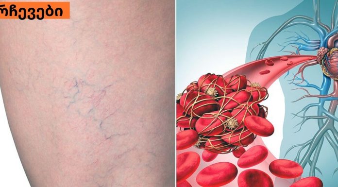 ვასკულიტი: რა უნდა იცოდეთ სისხლძარღვთა ანთების შესახებ