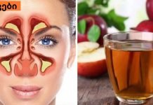 ვაშლის ძმრის რეალური გამოყენება: ყელის და ცხვირის მკურნალობა