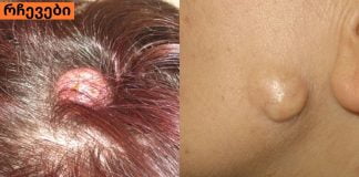 შეიძლება თუ არა ათერომის( ჩირქგროვა კანზე ) მკურნალობა სახლის პირობებში.