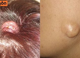 შეიძლება თუ არა ათერომის( ჩირქგროვა კანზე ) მკურნალობა სახლის პირობებში.