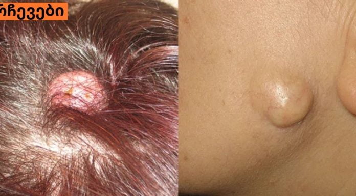 შეიძლება თუ არა ათერომის( ჩირქგროვა კანზე ) მკურნალობა სახლის პირობებში.