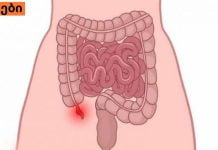 ბავშვებში ბრმა ნაწლავის გამომწვევი მიზეზები ,სიმპტომები ,მკურნალობა.