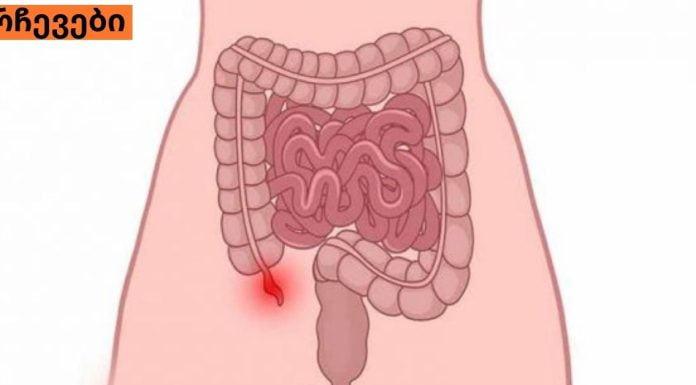 ბავშვებში ბრმა ნაწლავის გამომწვევი მიზეზები ,სიმპტომები ,მკურნალობა.