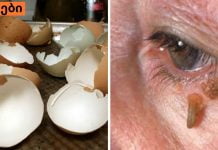 მეჭეჭები ,რომელსაც ვირუსი იწვევს განკურნებადია უმარტივესი მეთოდით,სცადეთ.