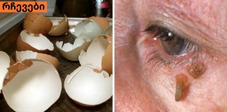 მეჭეჭები ,რომელსაც ვირუსი იწვევს განკურნებადია უმარტივესი მეთოდით,სცადეთ.