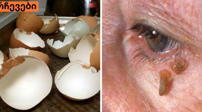 მეჭეჭები ,რომელსაც ვირუსი იწვევს განკურნებადია უმარტივესი მეთოდით,სცადეთ.