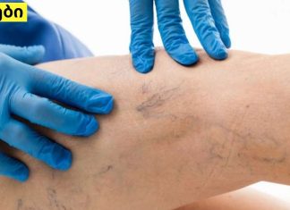 როგორ ვუმკურნალოთ ვენების თრომბოზს ამ ორი ინგრედიენტის დახმარებით? ეფექტურია