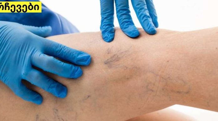 როგორ ვუმკურნალოთ ვენების თრომბოზს ამ ორი ინგრედიენტის დახმარებით? ეფექტურია