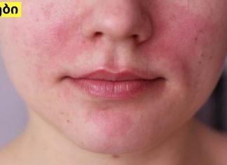 5 ხალხური საშუალება, რომელიც დაგეხმარებათ დერმატიტის განკურნებაში.