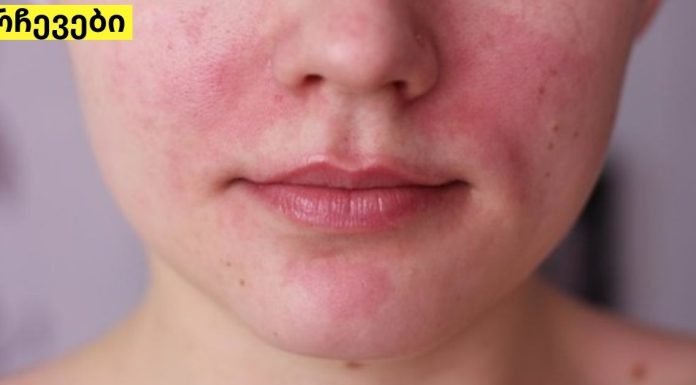 5 ხალხური საშუალება, რომელიც დაგეხმარებათ დერმატიტის განკურნებაში.