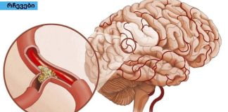 მაღალი წნევა და ტკივილი თავის არეში: როგორ აღვადგინოთ სისხლძარღვების ელასტიურობა წამლების გარეშე