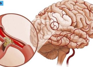 მაღალი წნევა და ტკივილი თავის არეში: როგორ აღვადგინოთ სისხლძარღვების ელასტიურობა წამლების გარეშე