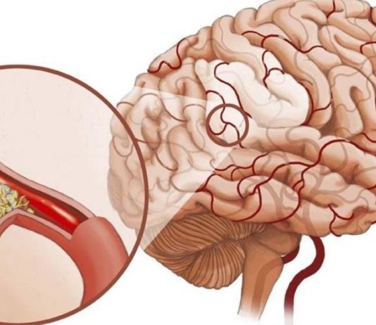 მაღალი წნევა და ტკივილი თავის არეში: როგორ აღვადგინოთ სისხლძარღვების ელასტიურობა წამლების გარეშე