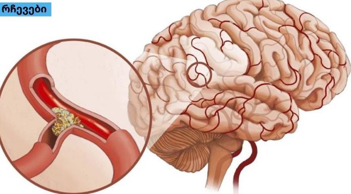 მაღალი წნევა და ტკივილი თავის არეში: როგორ აღვადგინოთ სისხლძარღვების ელასტიურობა წამლების გარეშე